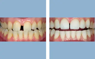 Before and After